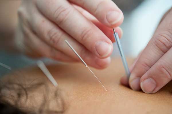 acupuncture services